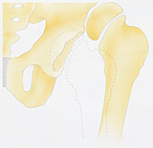 Dislocated hip joint, illustration