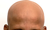 Alopecia totalis