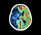 Stroke, CT scan