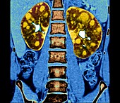 Polycystic kidneys, CT scan