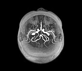 Epilepsy, MRI angiography