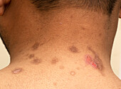 Pemphigus vulgaris lesions