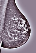 Breast cancer, X-ray