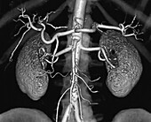 Healthy kidneys, 3D CT scan