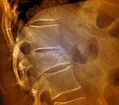 Fractured lumbar vertebra, X-ray