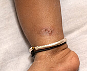 Scabies infection on the skin