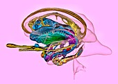 Limbic system in Alzheimer's disease, 3D MRI scan