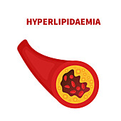 Hyperlipidaemia, conceptual illustration