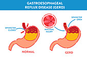 Gastroesophageal reflux disease, illustration
