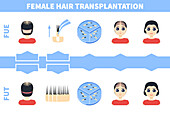Hair transplantation in women, illustration