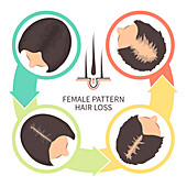 Female pattern hair loss, illustration