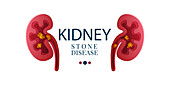 Kidney stone disease, conceptual illustration