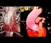 Aortic aneurysm, CT angiogram