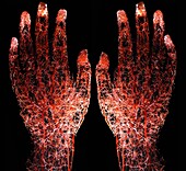 Blood vessels of human hands injected with resin