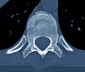 Fractured spine vertebra, CT scan