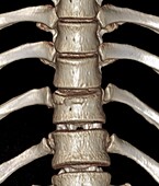 Thoracic spine fracture, 3D CT scan