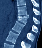 Thoracic spine fracture, CT scan