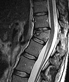 Thoracic spine fracture, MRI scan