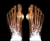 Gout, X-ray