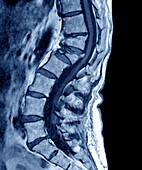 Osteoporosis, MRI scan