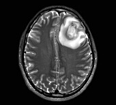 Brain abscess, CT scan