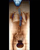 Harrington rod spinal implants in scoliosis, X-ray