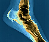 Heel pain, X-ray