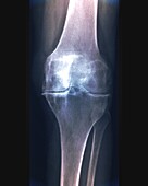 Rheumatoid arthritis, X-ray