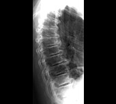 Back pain, X-ray