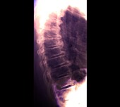 Back pain, X-ray