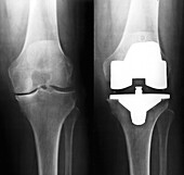 Knee replacement for osteoarthritis, X-ray