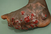Foot of a mycetoma patient