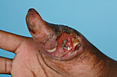 Hand of a mycetoma patient