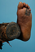 Foot of a mycetoma patient