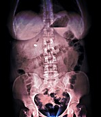 Gastric balloon, X-ray