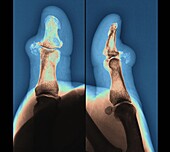 Pseudogout of a thumb, X-ray scans