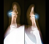 Pseudogout of a thumb, X-ray scans