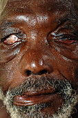 Man with leprosy