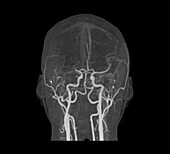 Thrombosis, MRI angiogram scan