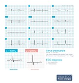 T wave changes, illustration