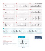 Normal ECG, illustration