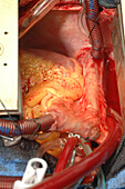 Mitral valve replacement surgery