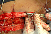Mitral valve replacement surgery