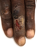 Ulcer on finger of leprosy patient
