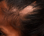 Post inflammatory pemphigoid on the scalp