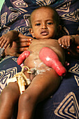 Baby boy with a colostomy
