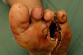 Diabetic septic foot