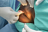 Haemorrhoid surgery