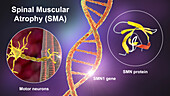 Spinal muscular atrophy, illustration