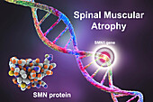 Spinal muscular atrophy, illustration